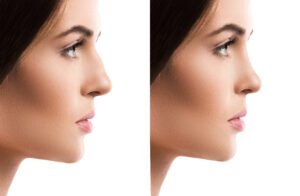 Rhinoplasty Pittsburgh